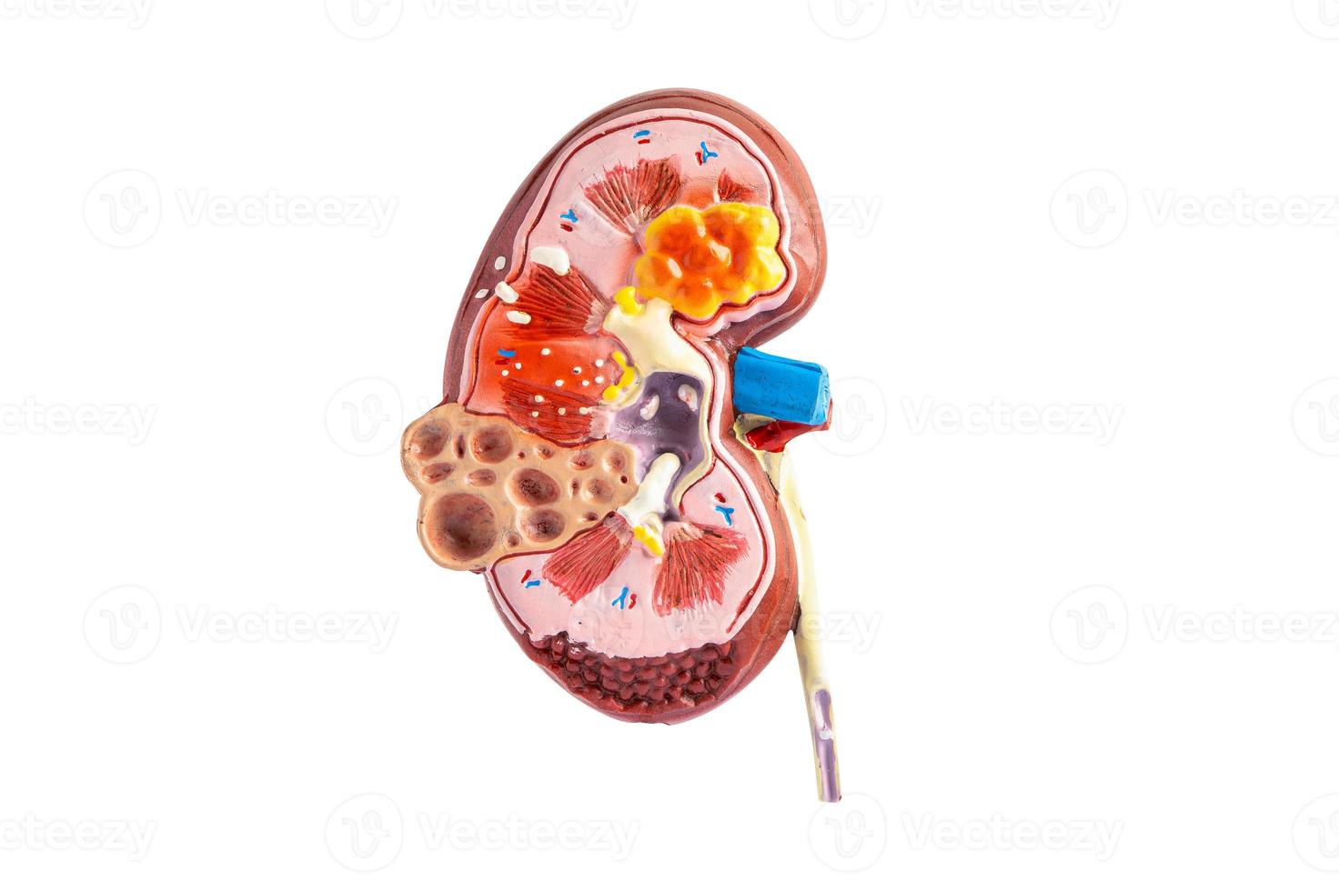 nier ziekte, chronisch nier ziekte ckd, model- voor studie geïsoleerd Aan wit achtergrond met knipsel pad. foto