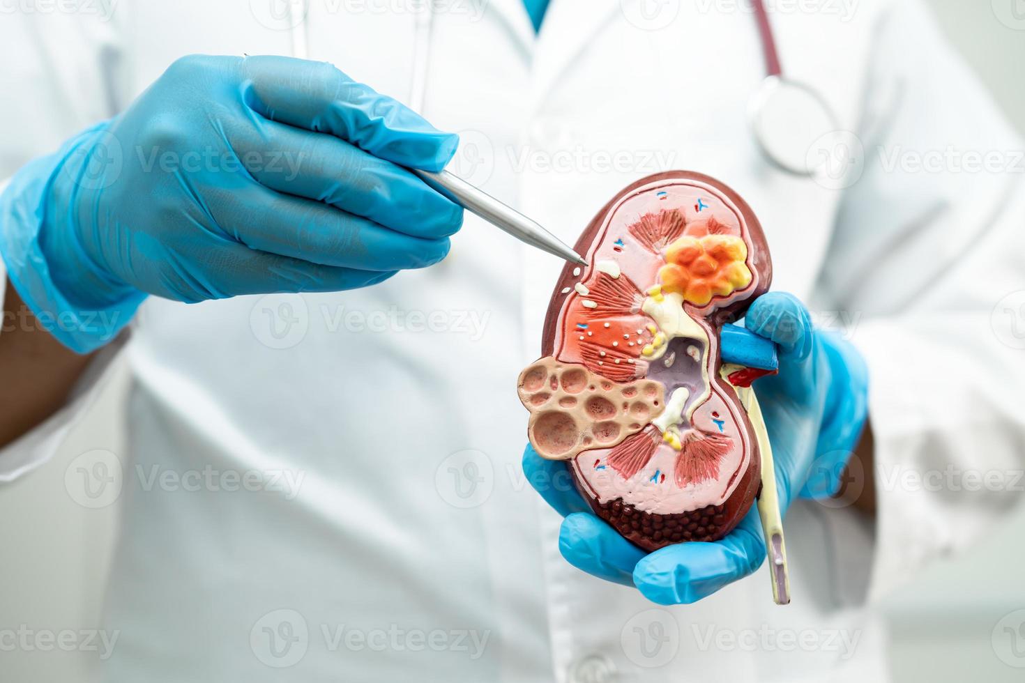 nier ziekte, chronisch nier ziekte ckd, dokter houden model- naar studie en traktatie in ziekenhuis. foto