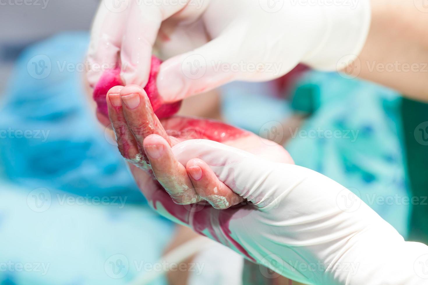 dokter desinfecteren de hand- van een geduldig voorafgaand naar een hand- chirurgie foto