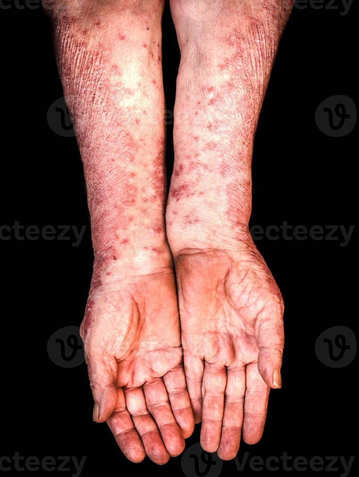 handen met psoriasis foto
