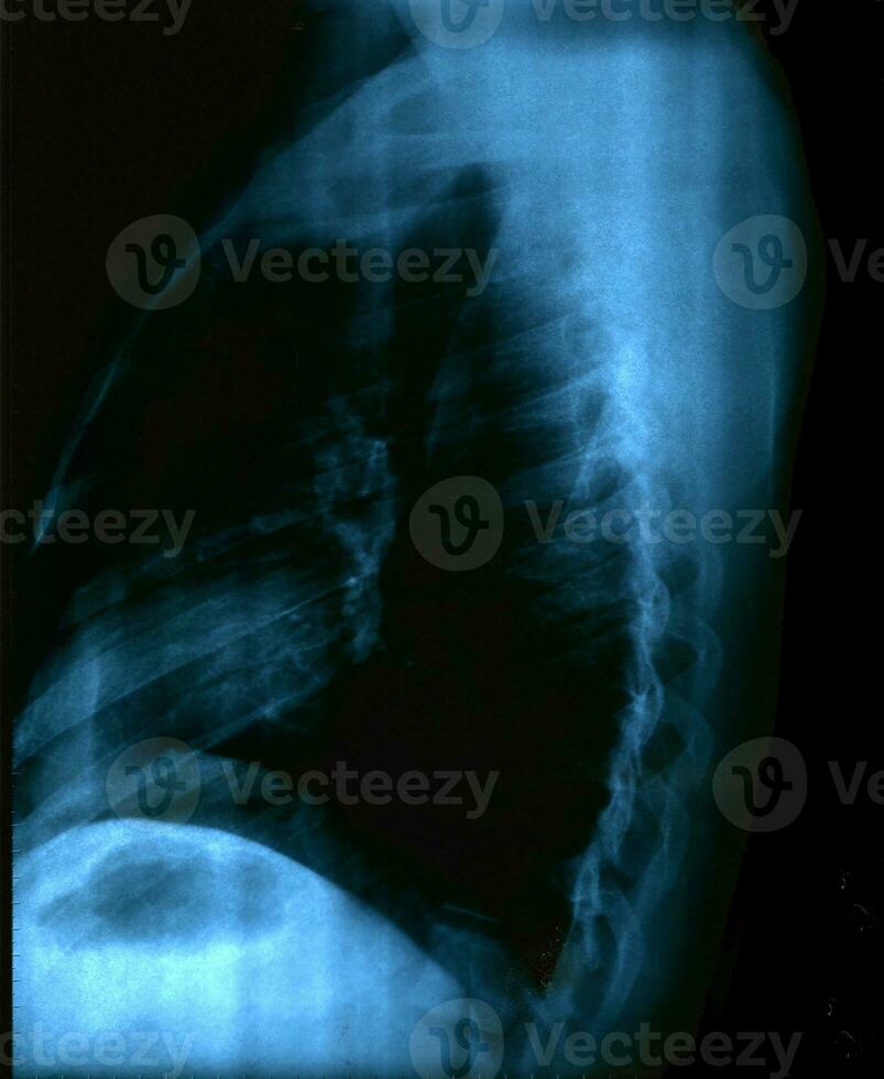 röntgenstraal beeld van menselijk gezond borst foto