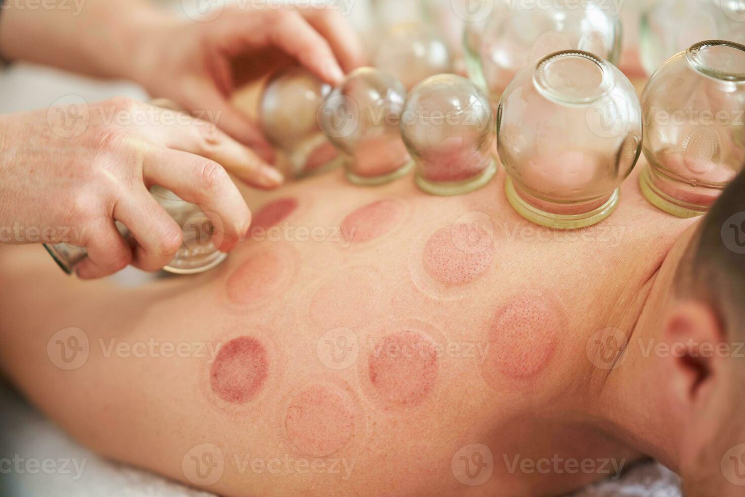 een afbeelding van een Mens hebben cupping behandeling foto