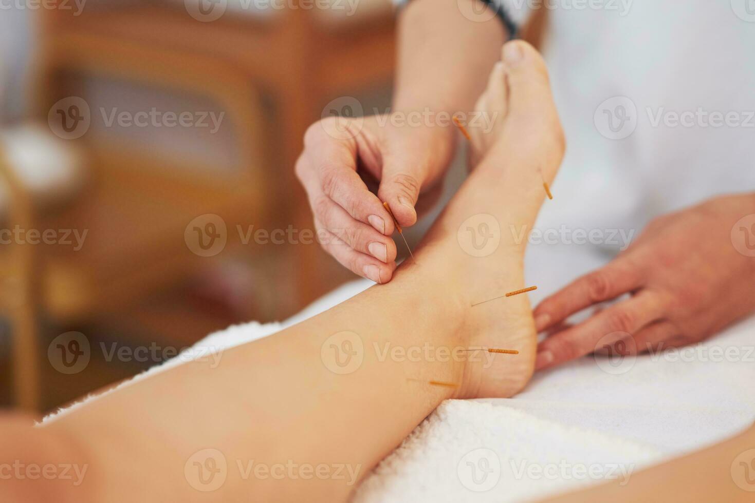 een acupunctuur naald- behandeling in de studio foto