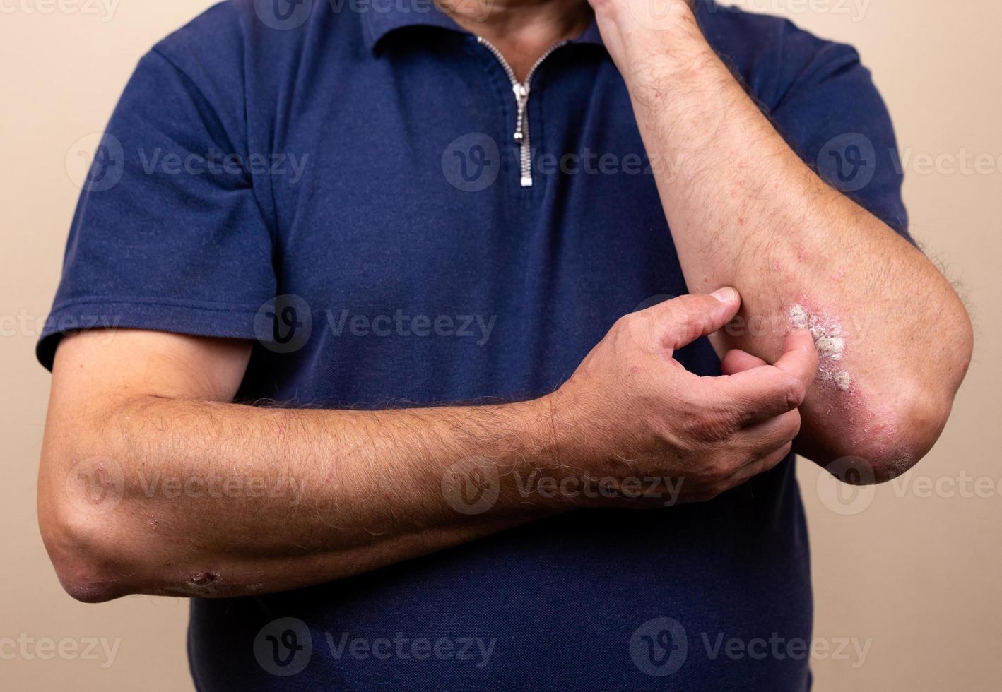 close-up dermatitis op de huid foto