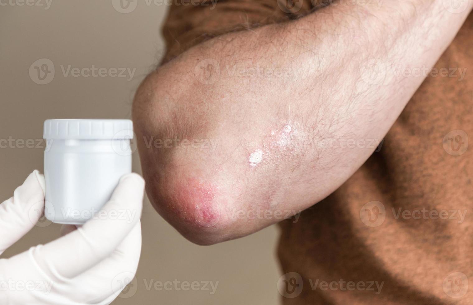 een dermatoloog in handschoenen brengt een therapeutische zalf aan op de aangetaste huid van een patiënt met psoriasis foto