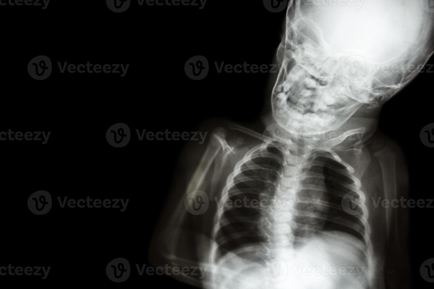 x-ray lichaam van kind en leeg gebied aan de linkerkant foto