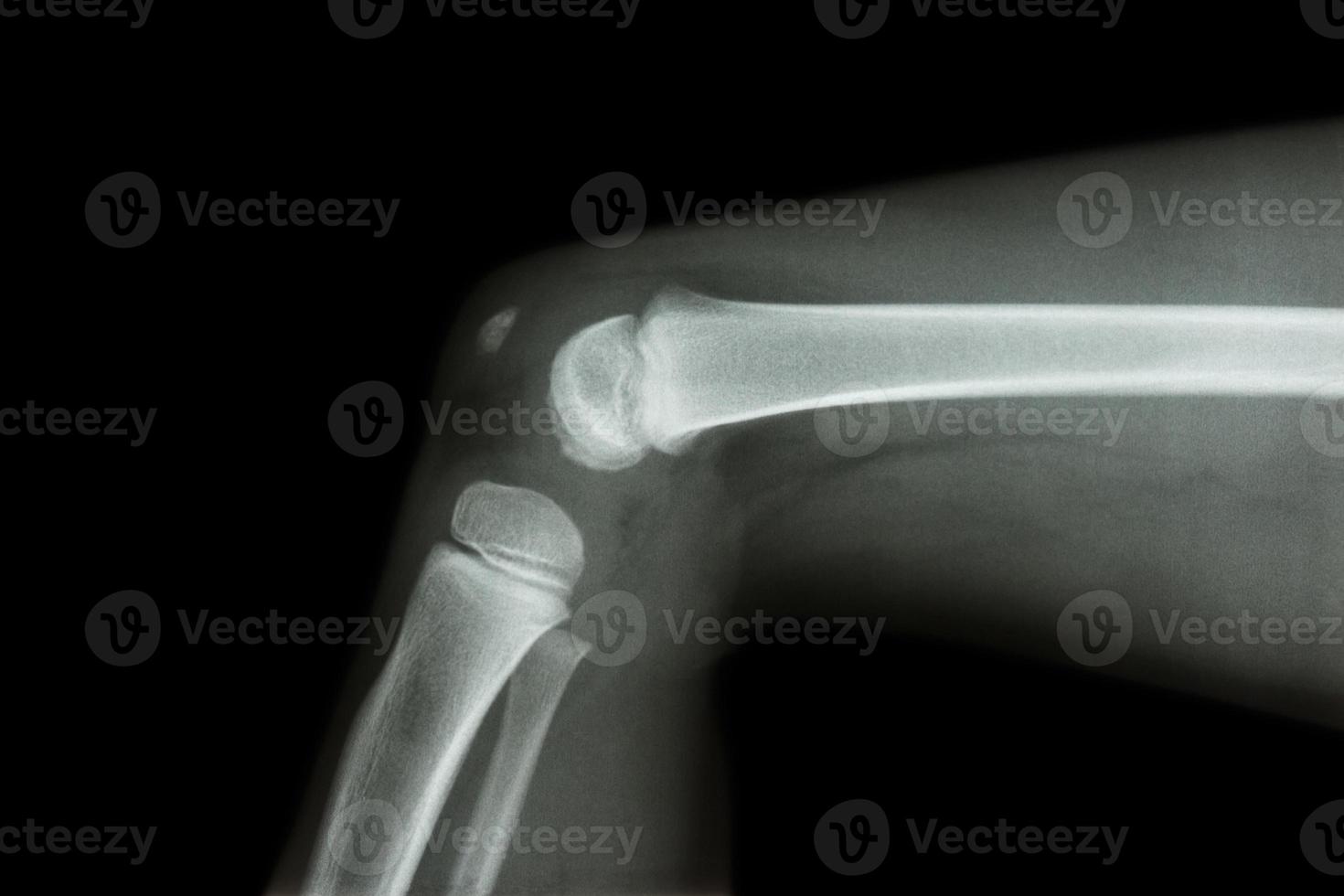 film xray knie zijaanzicht van kind foto