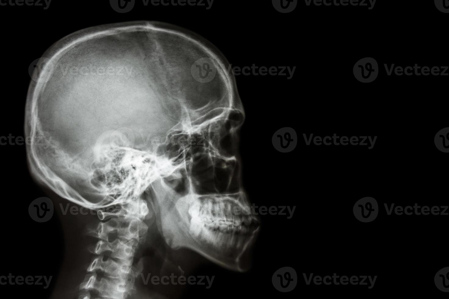 x ray aziatische schedel thaise mensen en leeg gebied aan de rechterkant foto