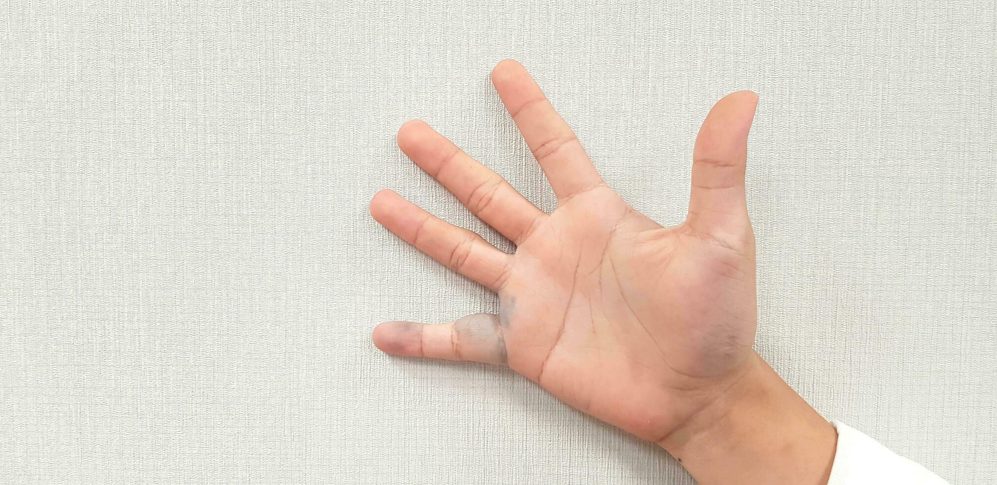 man's hand- heeft spataderen aderen in zijn Rechtsaf vinger en gezwollen of ontstoken geïsoleerd Aan wit behang muur. lichaam van menselijk een deel en gezondheidszorg of behandeling concept. foto