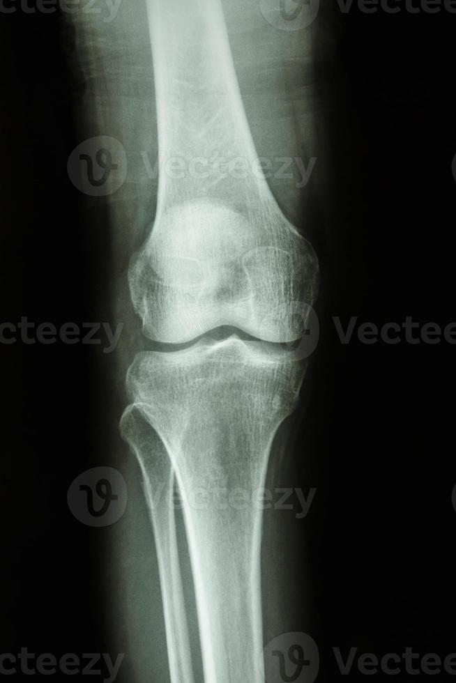 film röntgenfoto knie ap weergave toon normaal menselijk kniegewricht vooraanzicht foto