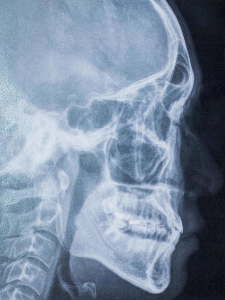 panoramische tandheelkundige röntgenfoto foto