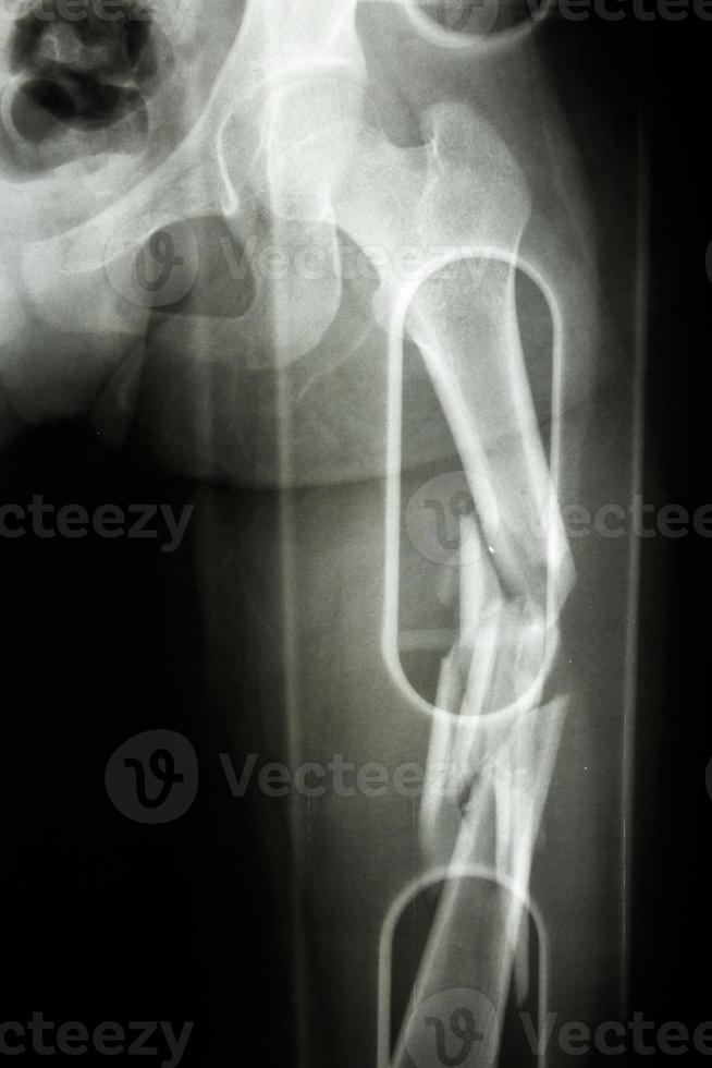 film x-ray show verkleinde fractuur schacht van dijbeen foto