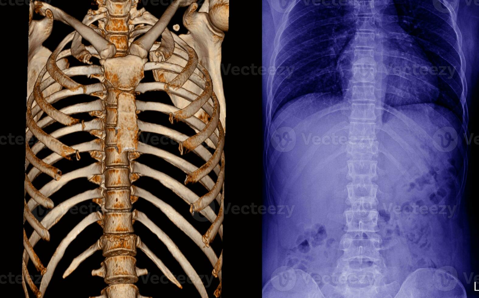röntgenstraal en ct scannen thoracaal wervelkolom foto