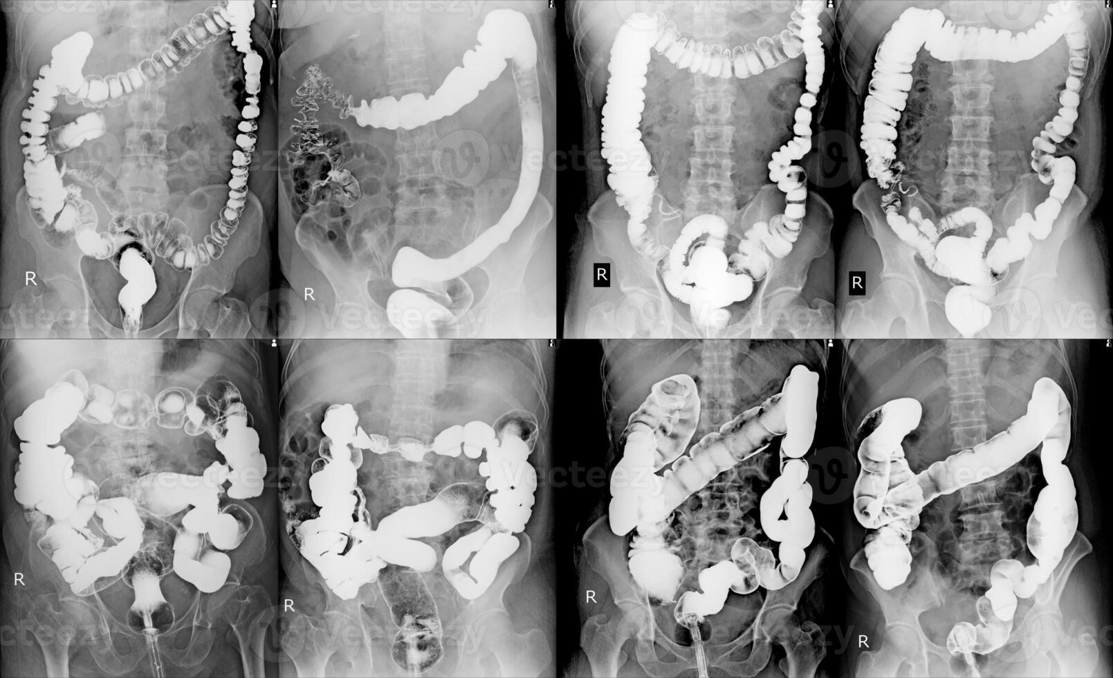 afbeelding van de dikke darm x-ray foto