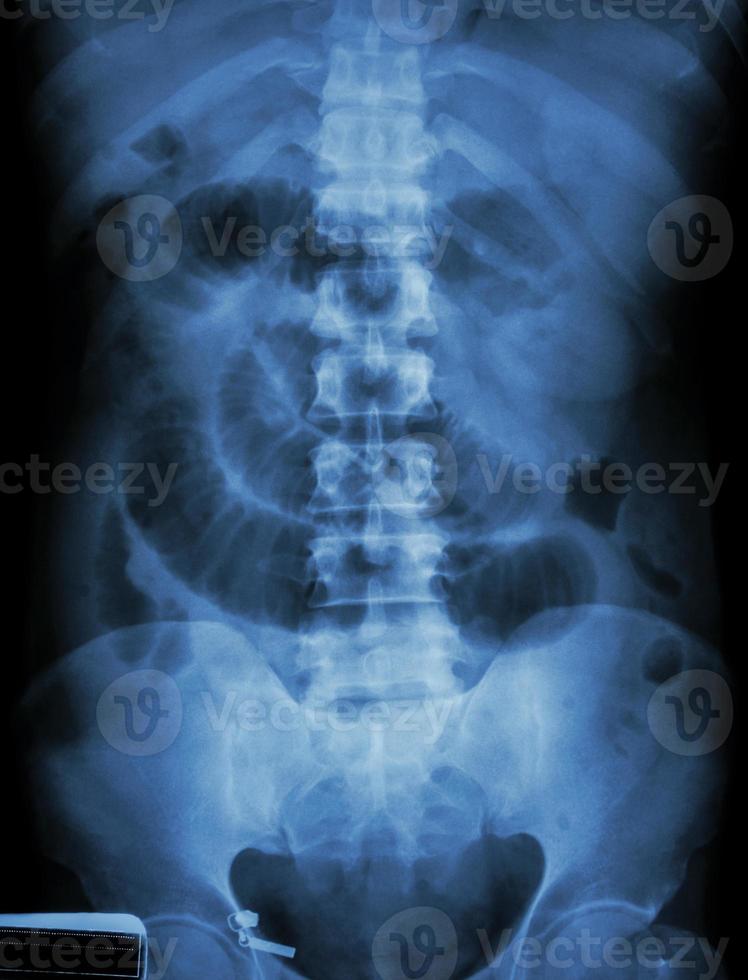 dunne darm obstructie film röntgenfoto buik liggende toon dunne darm verwijden foto