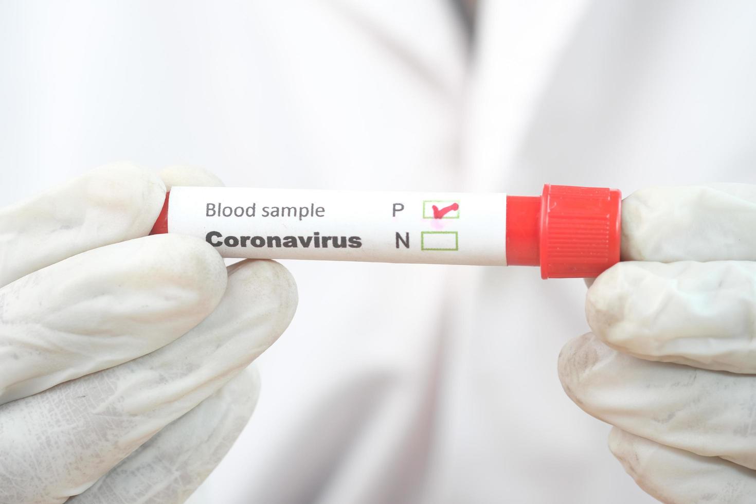 hand in witte medische handschoenen met bloedonderzoekbuis foto