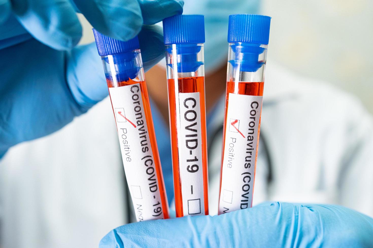 positief bloedinfectiemonster in reageerbuis voor covid-19 coronavirus in laboratorium. wetenschapper die de patiënt in het ziekenhuis controleert en analyseert. foto