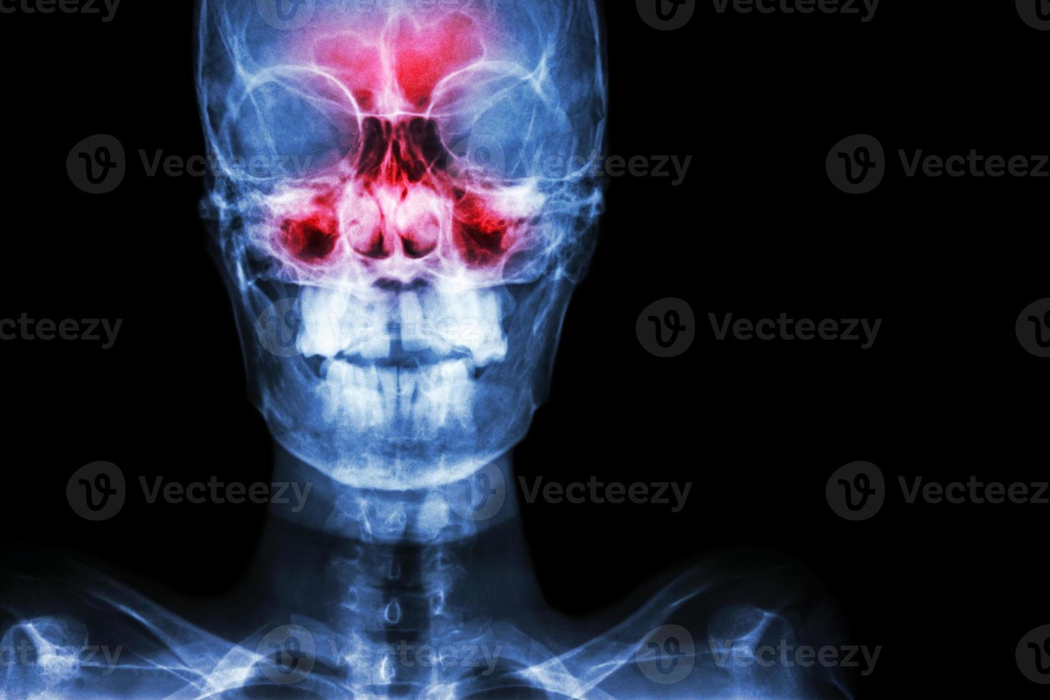 film röntgenfoto schedel ap anterieur - posterieur, toont infectie en ontsteking bij frontale sinus, ethmoid sinus, maxillaire sinus en blanco gebied aan de rechterkant foto