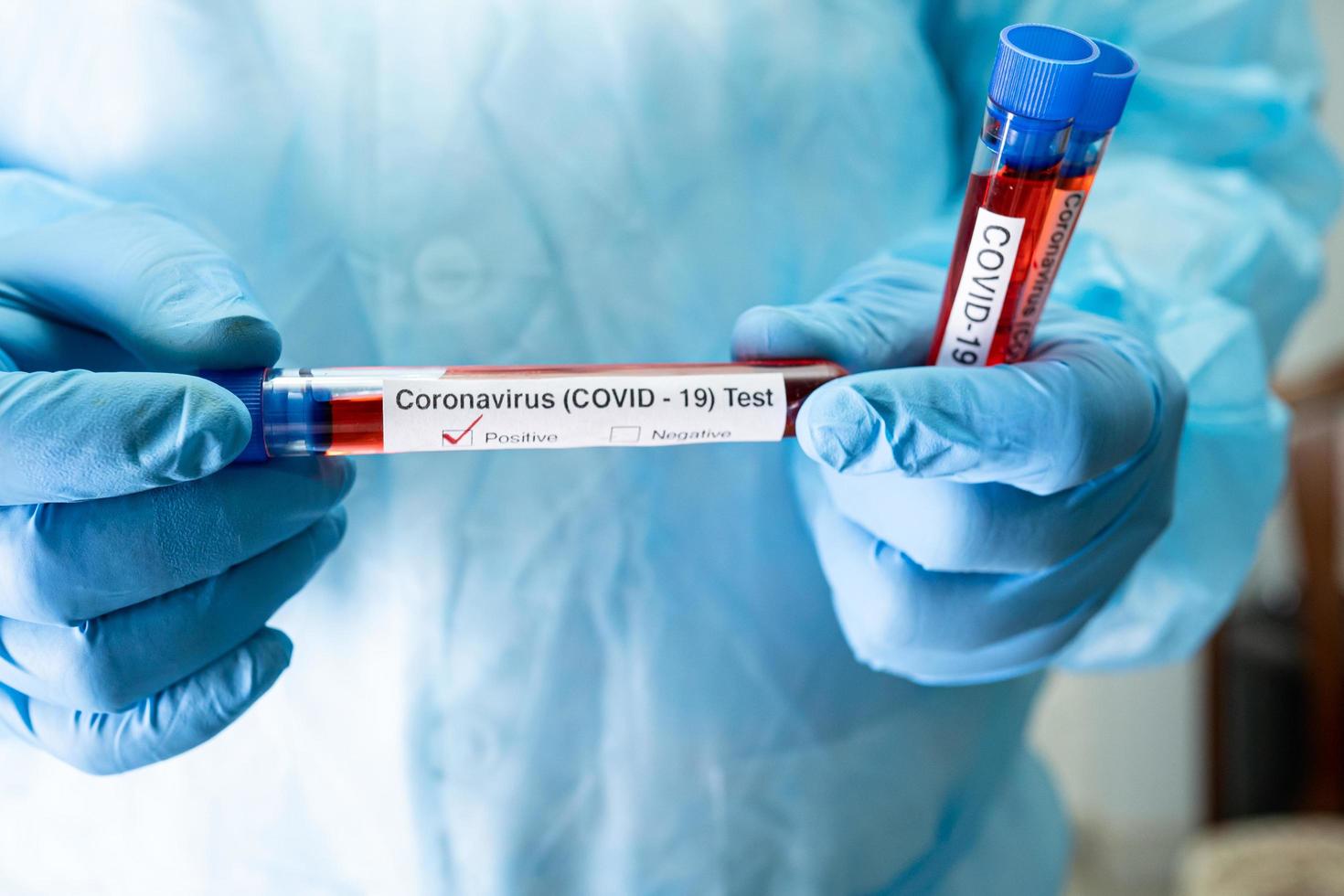 positief bloedinfectiemonster in reageerbuis voor covid-19 coronavirus in laboratorium. wetenschapper die de patiënt in het ziekenhuis controleert en analyseert. foto