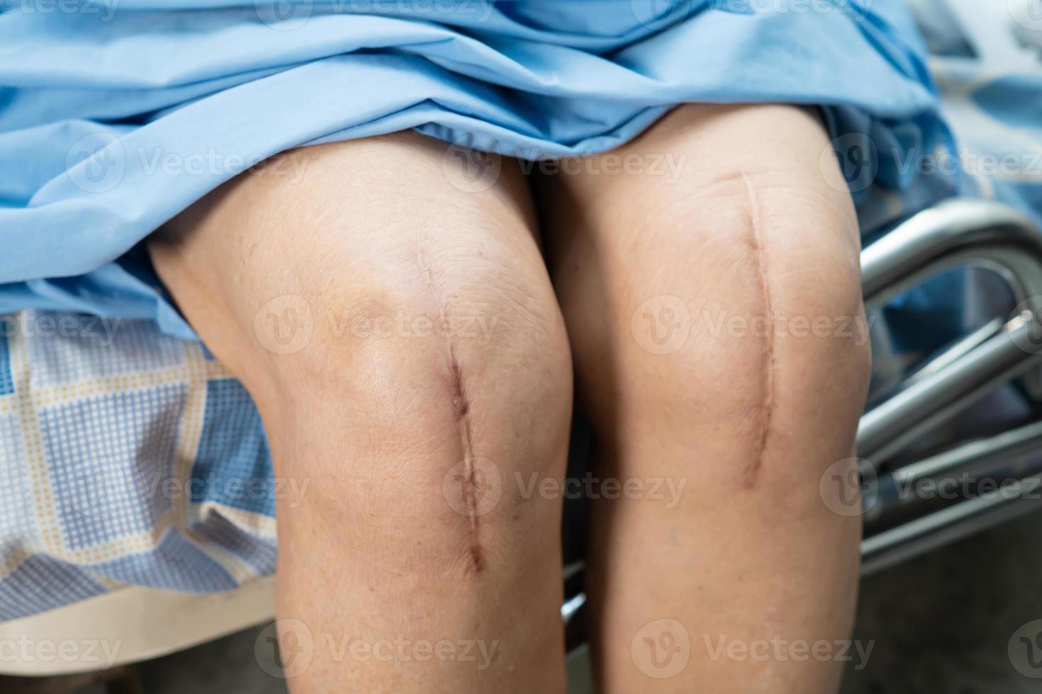 Aziatische senior vrouw patiënt laat haar littekens kniegewricht zien foto