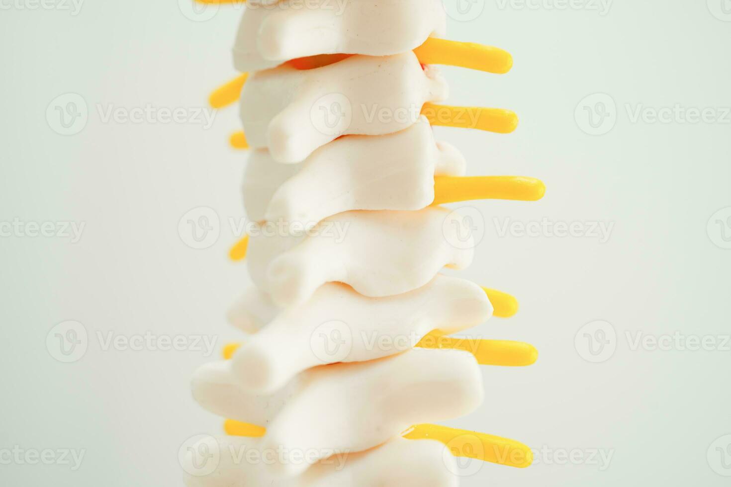 spinal zenuw en bot, lumbaal wervelkolom verplaatst hernia schijf fragment, model- voor behandeling medisch in de orthopedische afdeling. foto