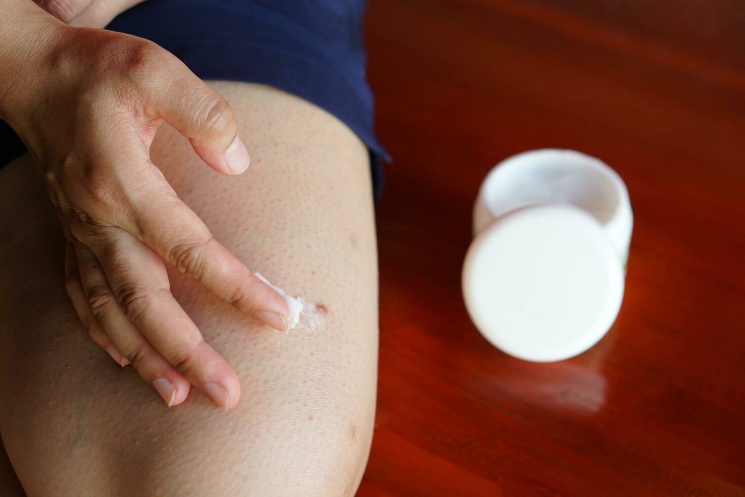 dichtbij uo vrouw hand- is toepassen medisch room Aan been huid. concept, Gezondheid zorg. huid zorg behandeling van jeukend, allergie, uitslag, droog huid, insecten beet, schimmel of dermatitis. zelf redmiddel Bij huis. foto