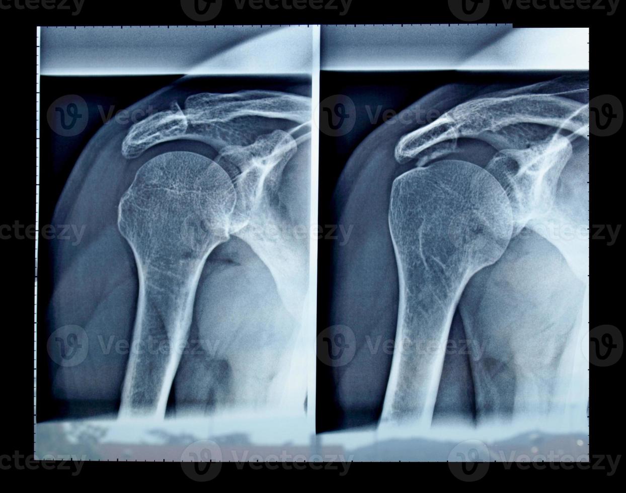 röntgenfoto van schouder foto