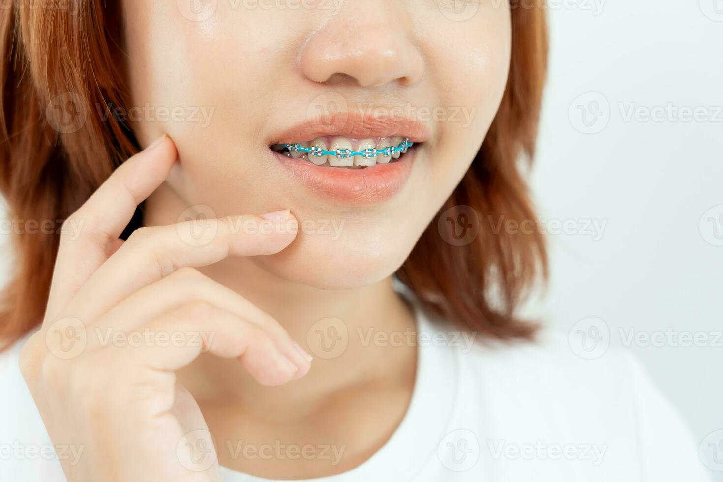 behandeling. tandheelkundig zorg. mooi Aziatisch vrouw gezond glimlach.metaal haakjes Aan tanden. jong vrouw glimlach met een beugel en tonen mooi van tanden, zorg na een beugel, zelfverzekerd in orthodontie foto