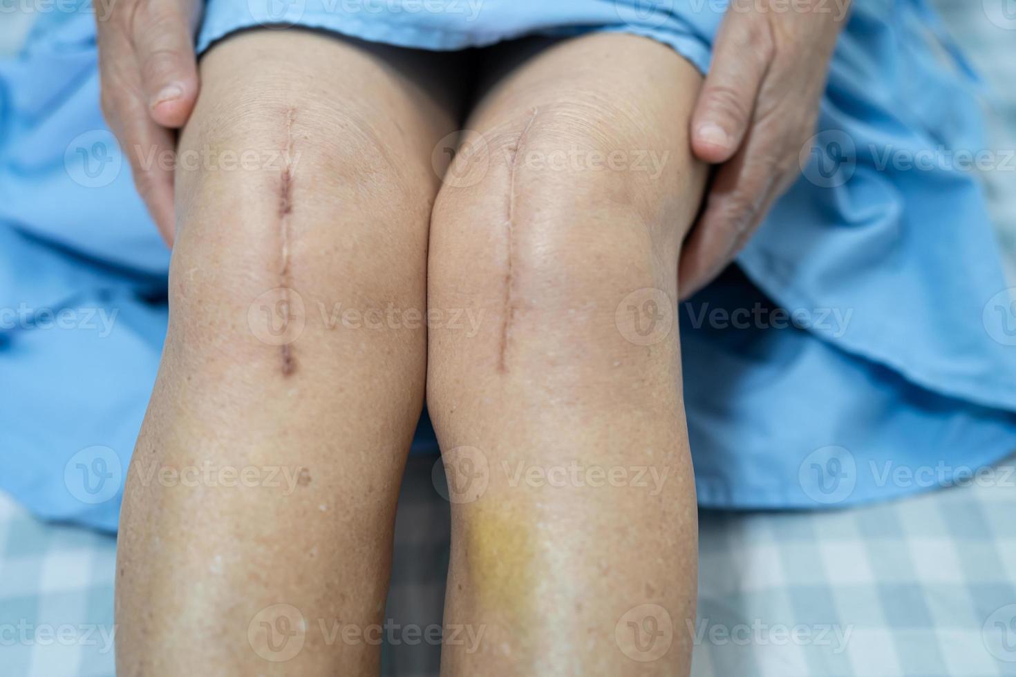 Aziatische senior vrouw patiënt laat haar littekens zien chirurgische totale knie foto