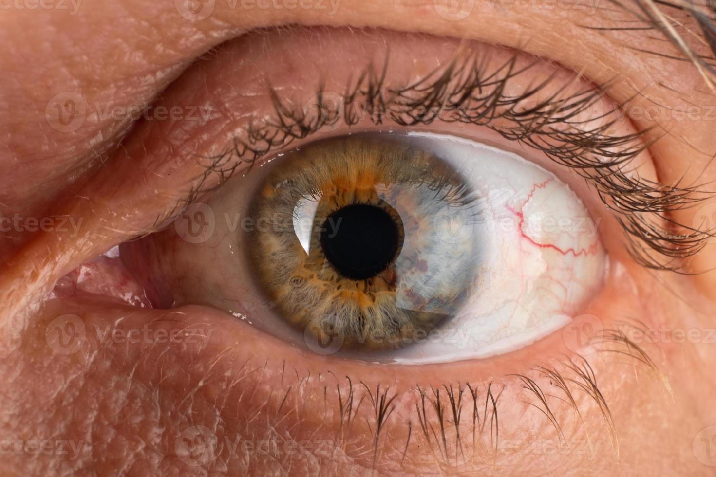 een oudere man oog close-up, oog met gediagnosticeerde keratoconus cornea dunner worden. foto
