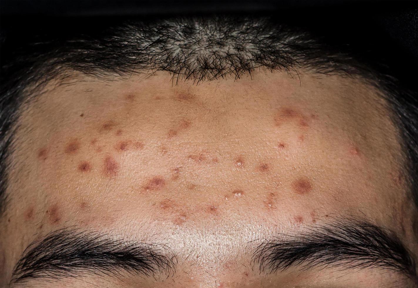 close-up van acne op de huid, acne op het gezicht veroorzaakt door hormoon. foto