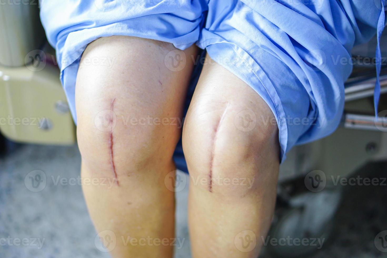 Aziatische senior patiënt laat haar littekens zien chirurgische kniegewrichtvervanging foto