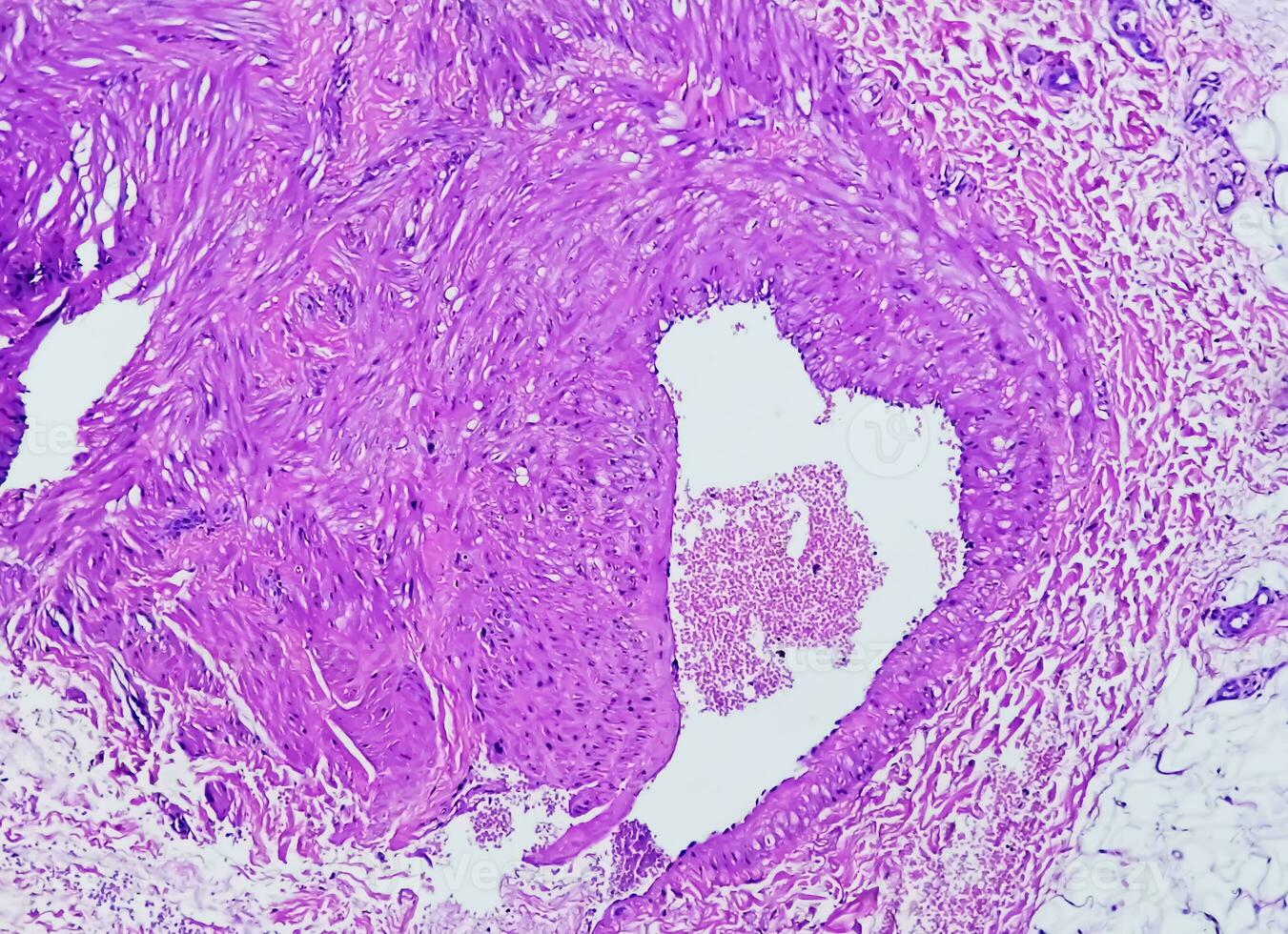 foto, prepatellair regio histologie tonen slijmbeursontsteking, acuut of chronisch bursitis. foto