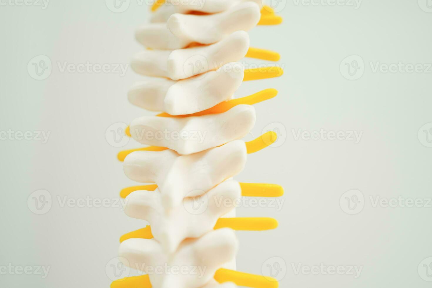 spinal zenuw en bot, lumbaal wervelkolom verplaatst hernia schijf fragment, model- voor behandeling medisch in de orthopedische afdeling. foto