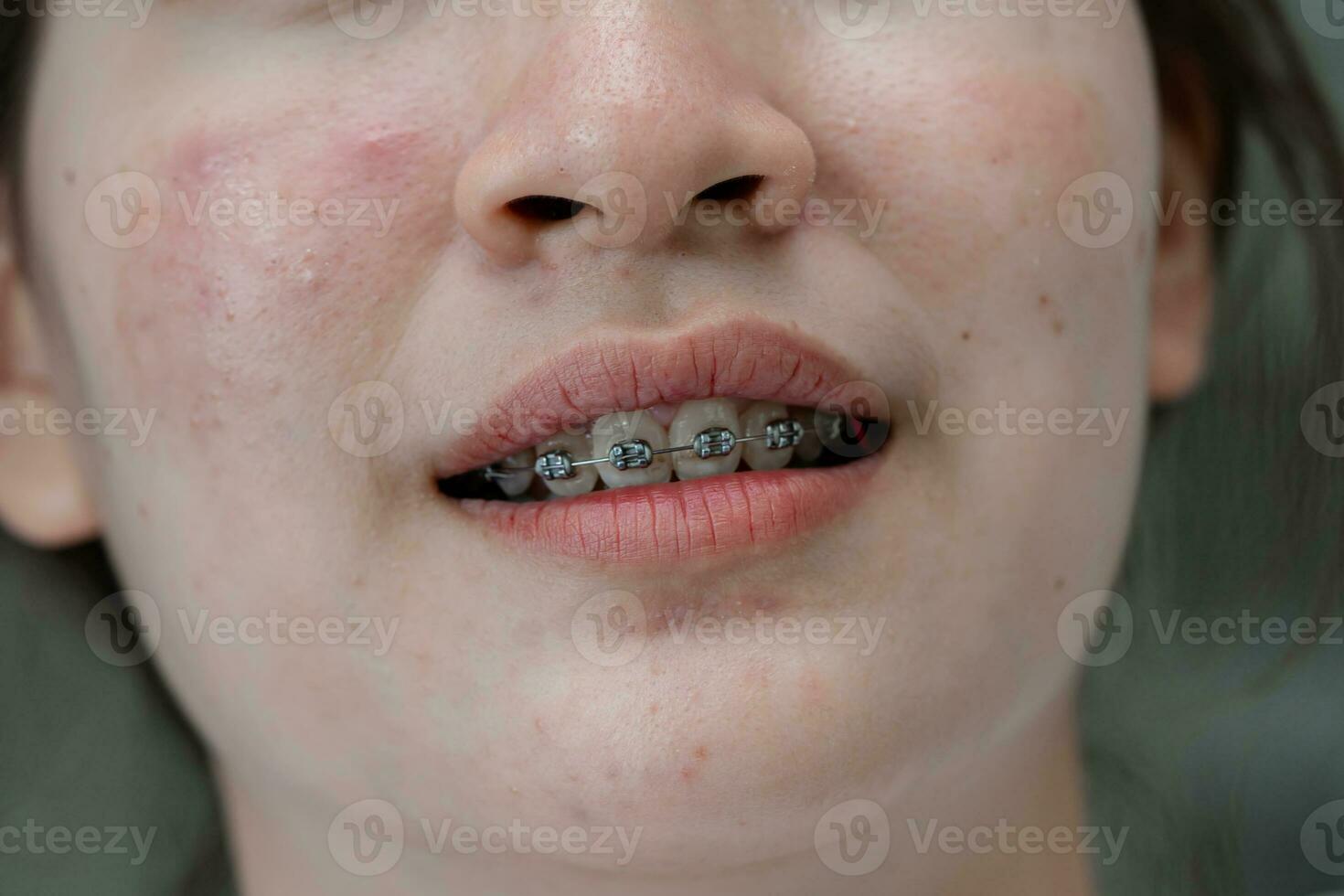 een beugel in tiener- meisje mond naar traktatie en schoonheid voor toenemen vertrouwen en mooi zo persoonlijkheid. foto