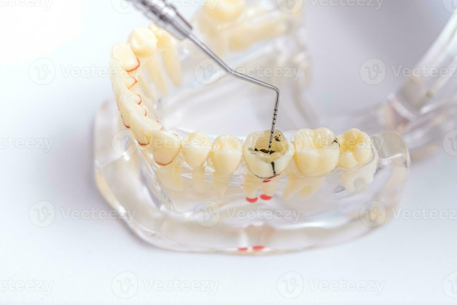 dokter orthodontist shows de instrument Aan cariës in de tanden foto