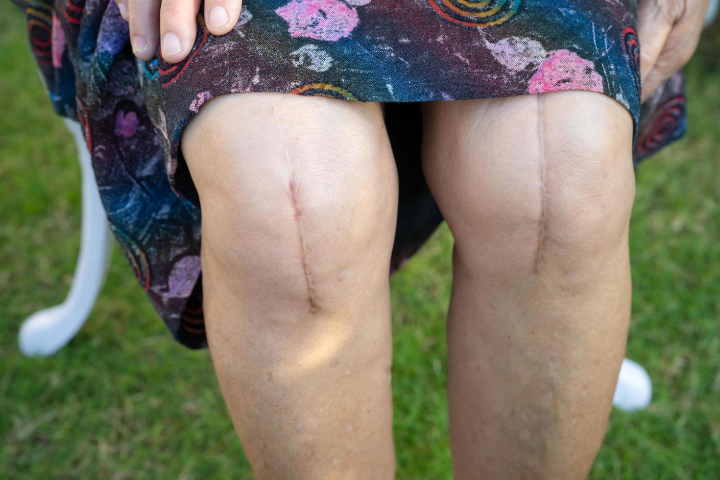 Aziatische senior dame oude vrouw patiënt laat haar littekens zien chirurgische totale vervanging van het kniegewricht foto