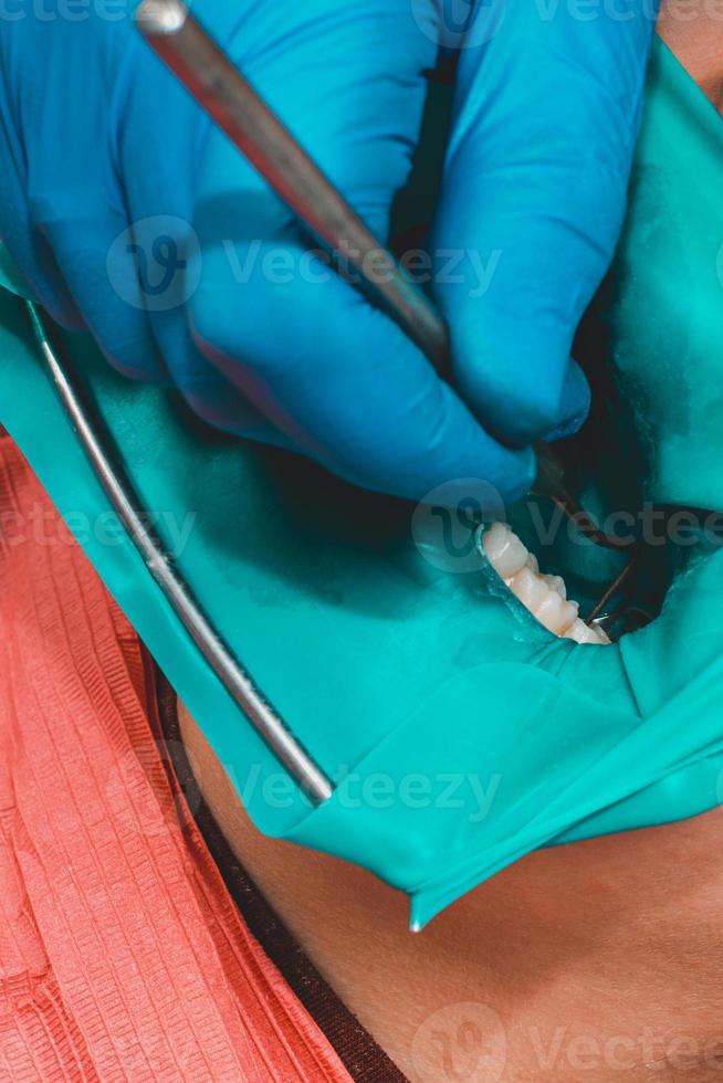 behandeling van posterieure tand foto