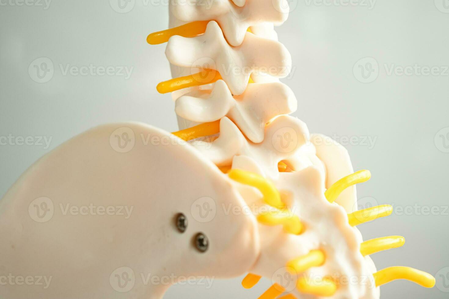 lumbaal wervelkolom verplaatst hernia schijf fragment, spinal zenuw en bot. model- voor behandeling medisch in de orthopedische afdeling. foto