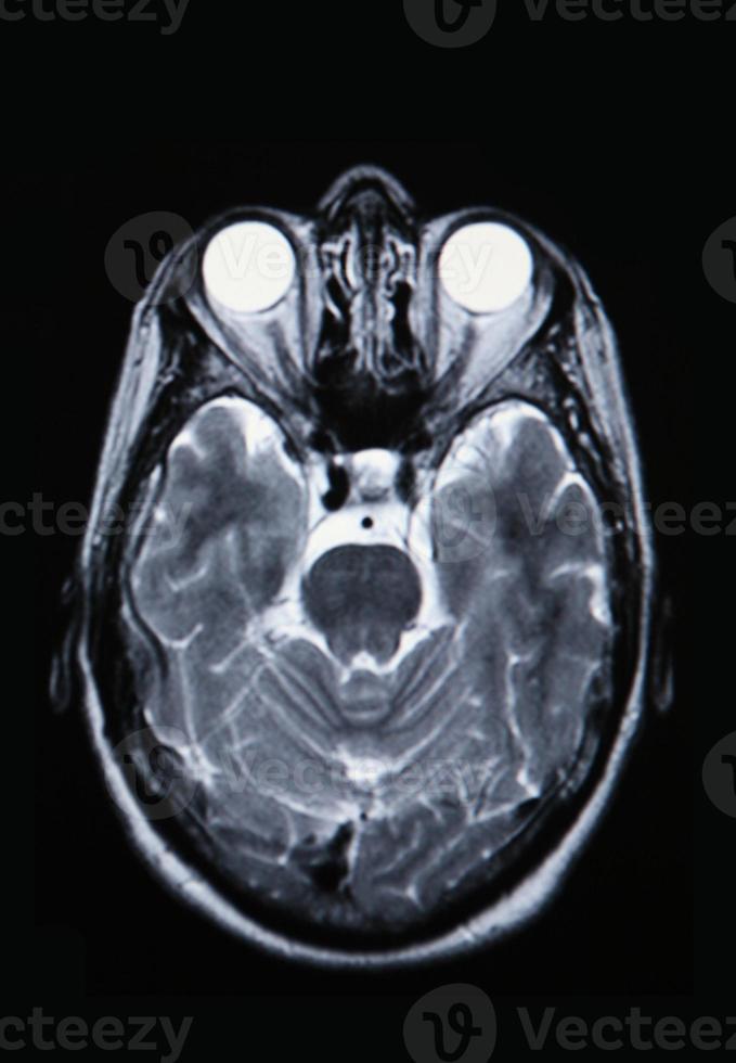 een echte mri mra van de hersenvasculatuur foto