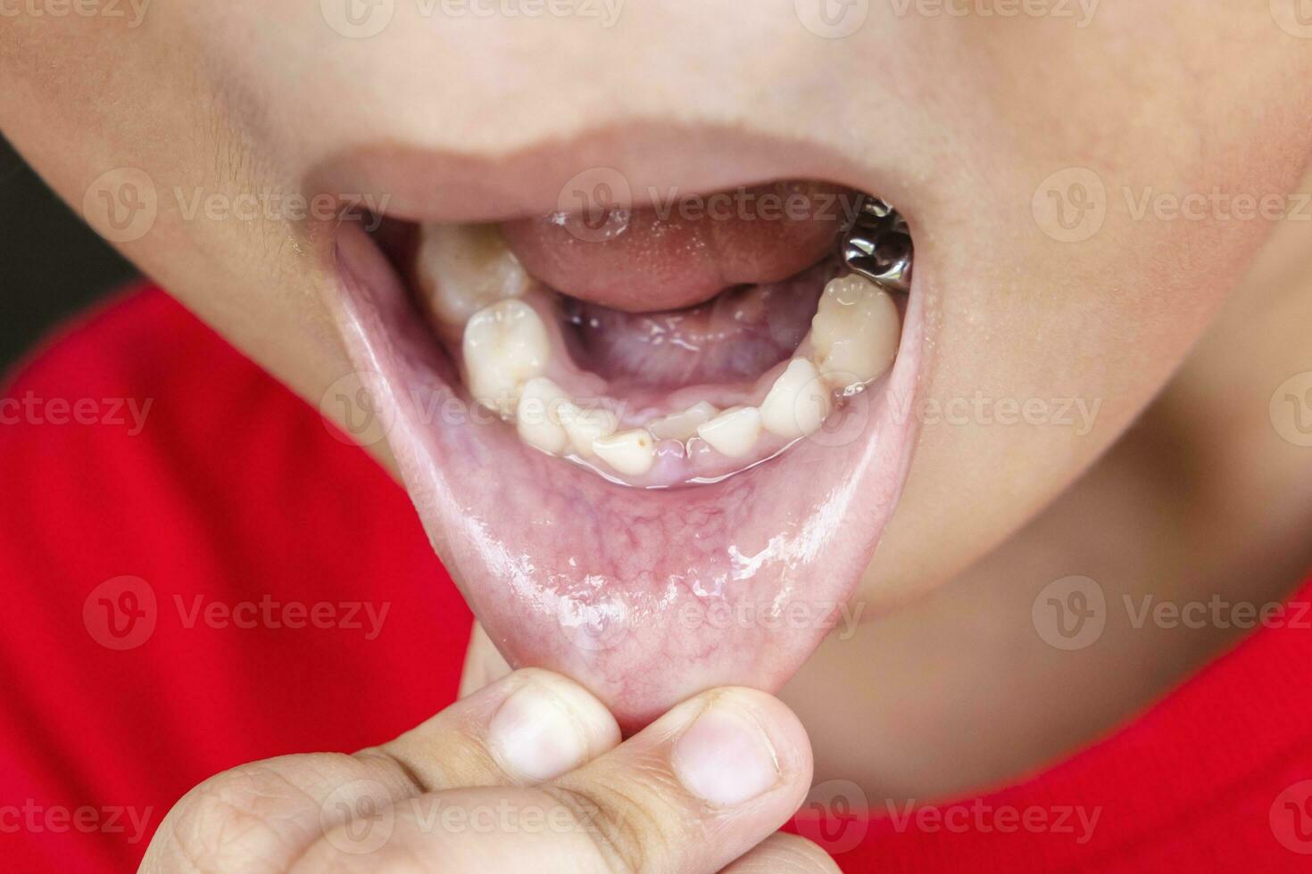 kind melk tanden vallen uit van gom. weinig jongen blijvend tand groeit in mond. schattig kind Open haar mond tonen tanden en tandvlees. concept van Gezondheid, tandarts, hygiëne, medisch, gezond tanden, tandheelkundig kliniek. foto