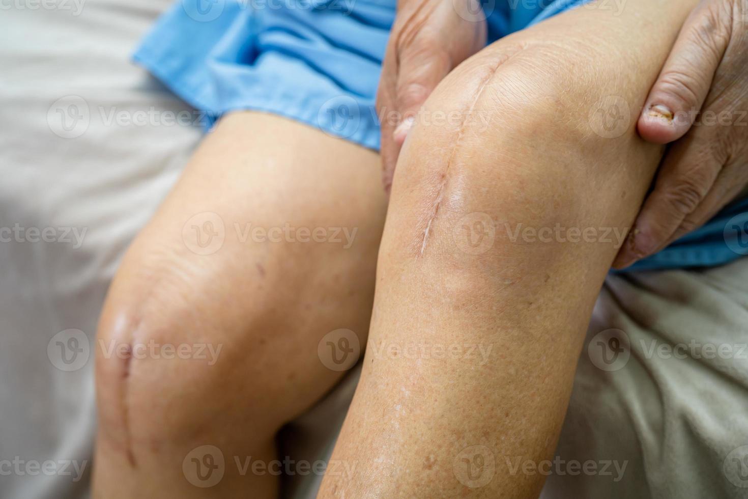Aziatische senior vrouw patiënt toont haar littekens chirurgische totale kniegewricht vervanging hechtdraad wond chirurgie artroplastiek op bed in verpleegafdeling ziekenhuis, gezond sterk medisch concept. foto