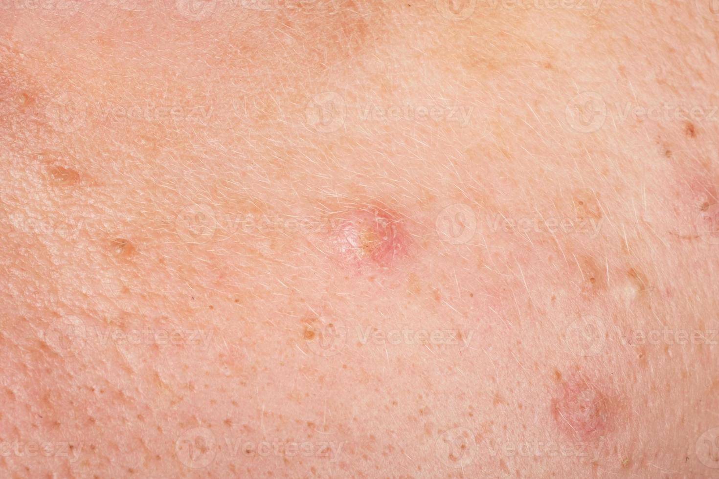 acne op het gezicht close-up, huidproblemen foto