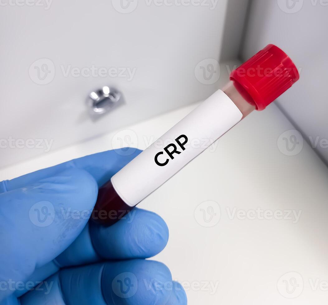 bloed monster voor crp of c reactief eiwit test gebruikt naar identificeren ontsteking of infectie in de lichaam foto