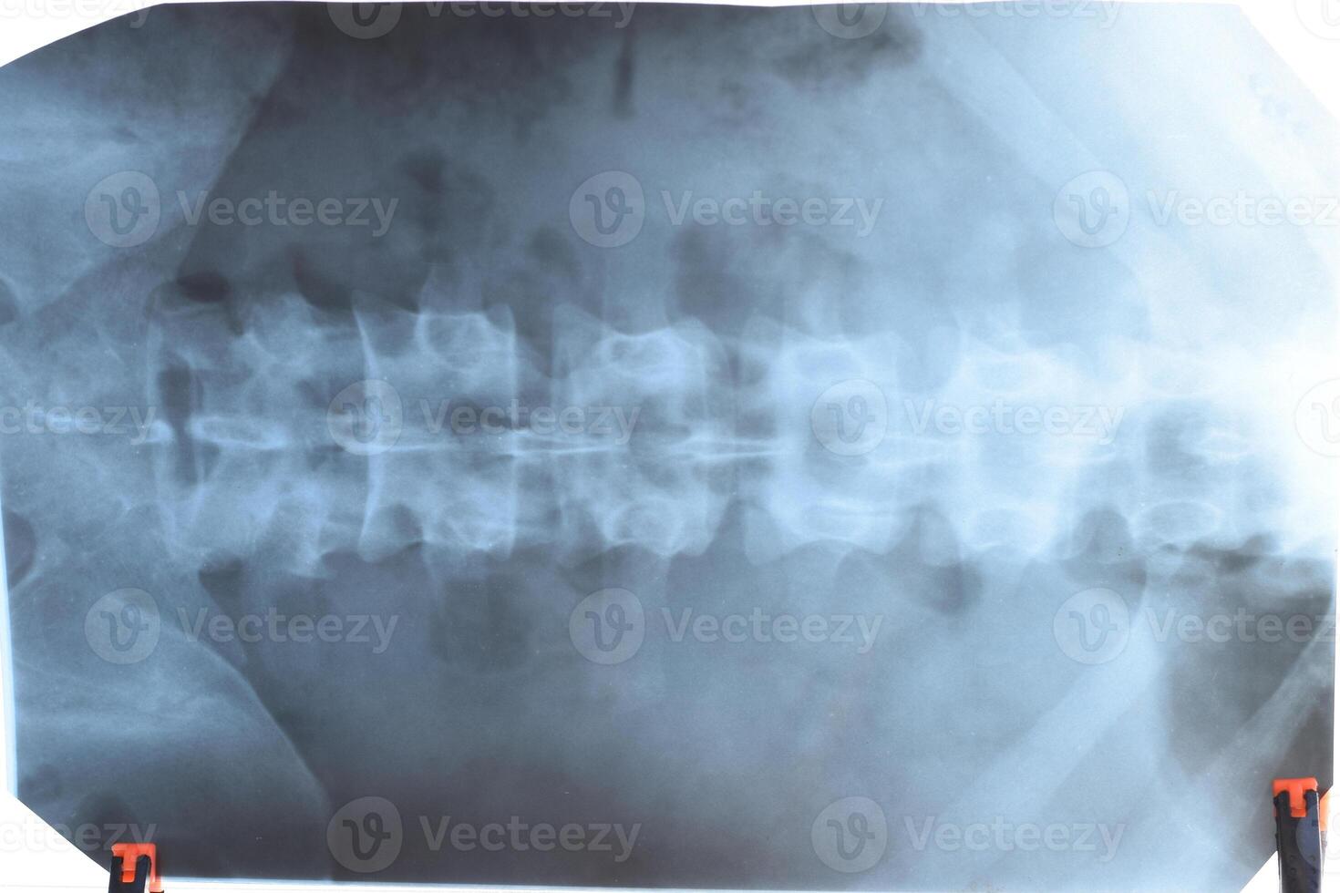 X straal van de lumbaal ruggengraat, wervelkolom Aan röntgenstraal foto