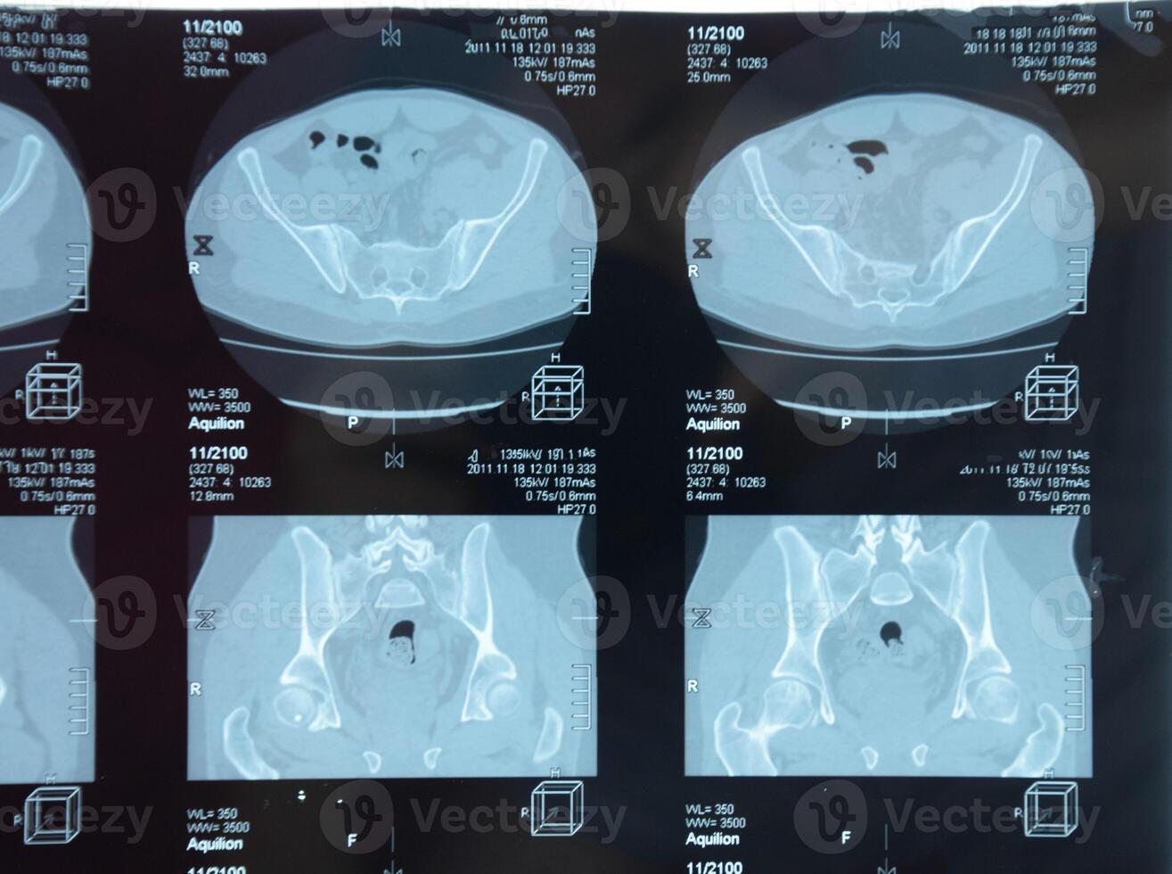 mri sacro-iliacaal articulatie. studie van ankylopoetica spondyloartritis geduldig. foto