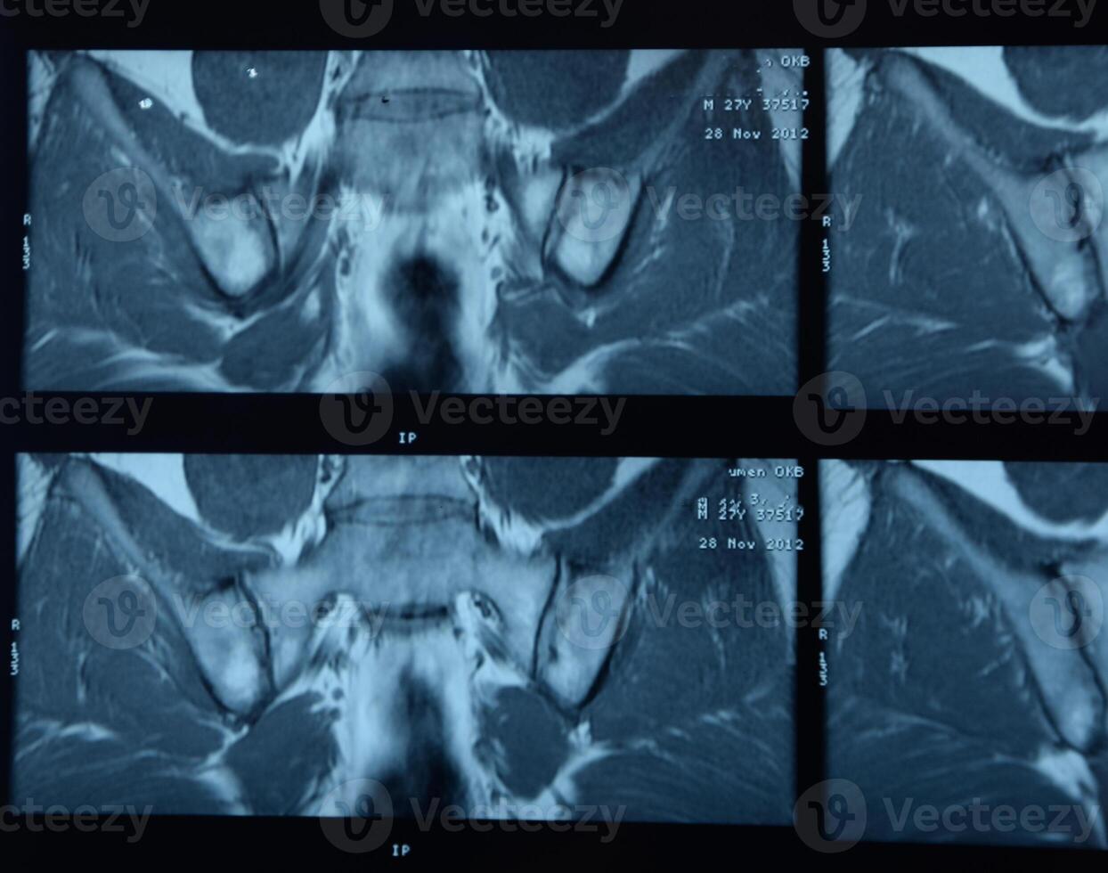 mri sacro-iliacaal articulatie. studie van ankylopoetica spondyloartritis geduldig. foto