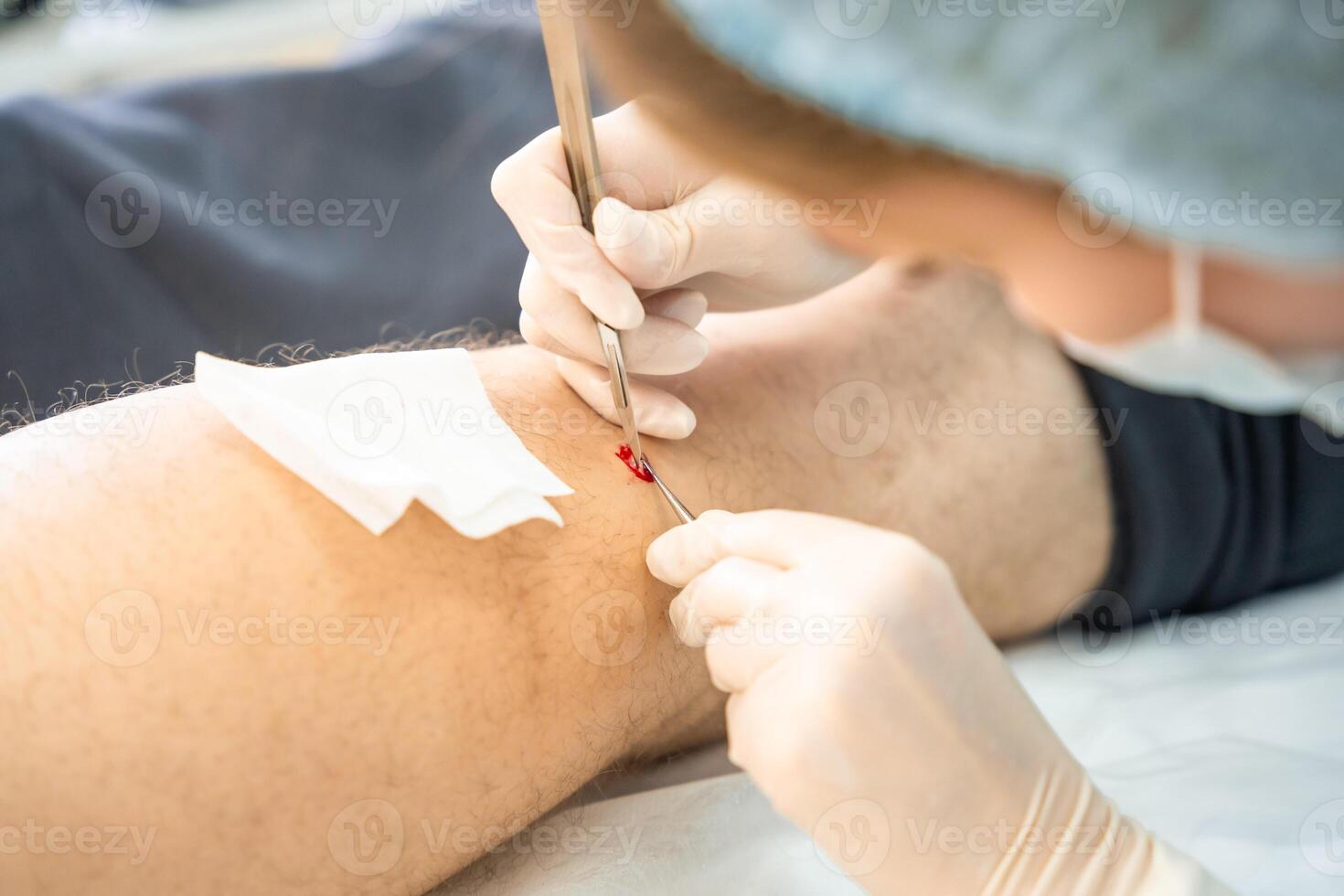 dermatoloog chirurg verwijdert huid ziekten met scalpel en pincet, kunstmatig operatie werkwijze foto