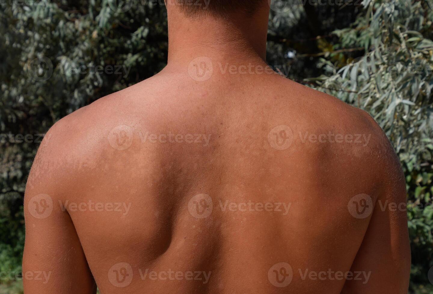 zonnebrand Aan de huid van de rug. afschilfering, huid schillen uit. gevaarlijk zon bruinen foto