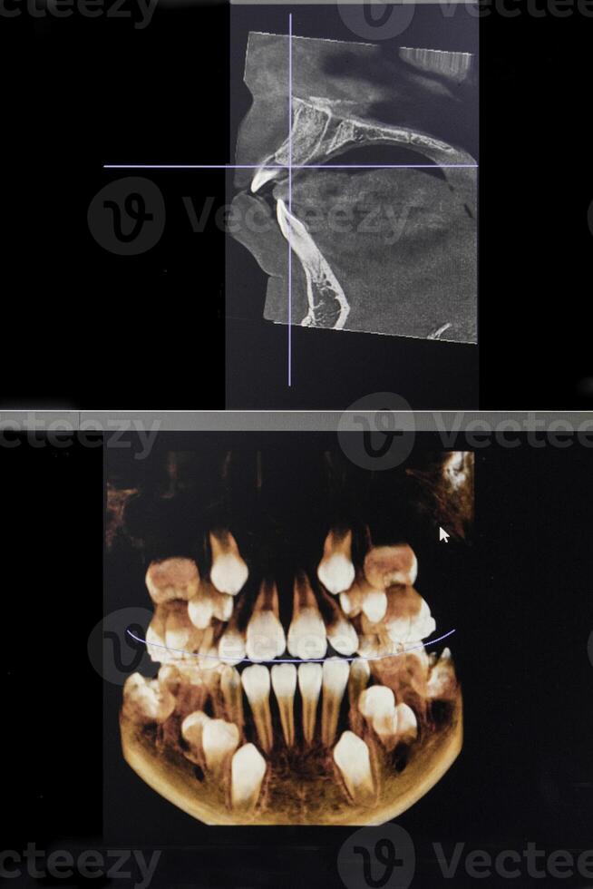 ct beeld van de tanden van een 9 jaar oud kind, met baby tanden, in verschillend projecties. cbct van twee kaken. foto